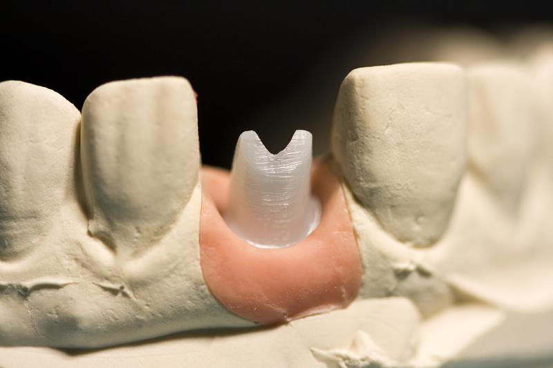 Implant Restoration Shelby Township, MI