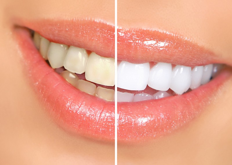 Teeth Whitening Shelby Township, MI